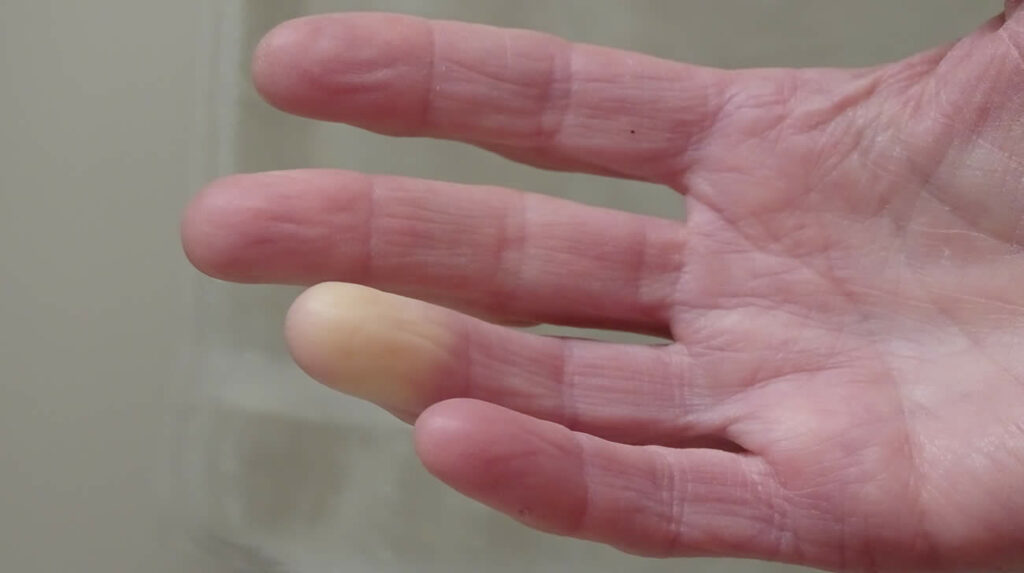 biofeedback per la sindrome di Raynaud